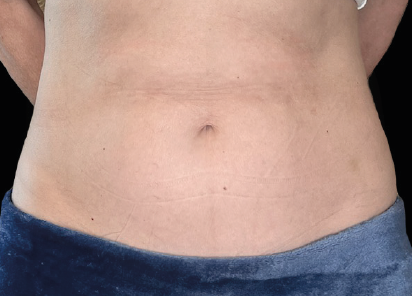 After EMSCULPT NEO abdomen treatment, six months after treatment, courtesy Catara Medical Spa.