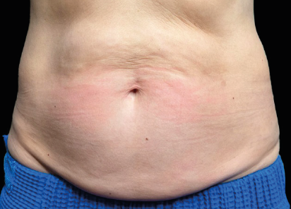 Before EMSCULPT NEO abdomen treatment, courtesy Catara Medical Spa.