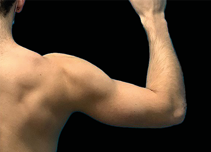 Before EMSCULPT NEO arms treatment, courtesy Carolyn Jacob, M.D.